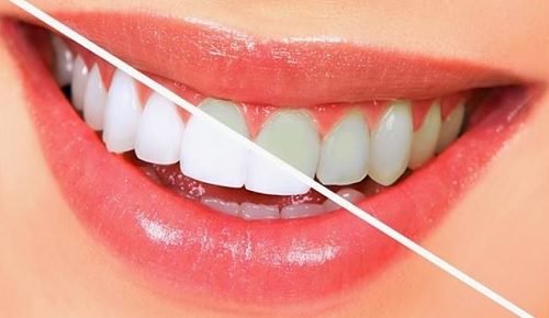 How to Keep Your Teeth Whitened on Your Time Dentist Reading
