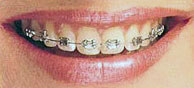 braces