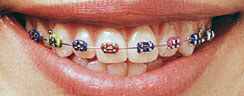 metal braces