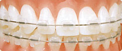 porcelain braces