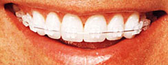 sapphire braces