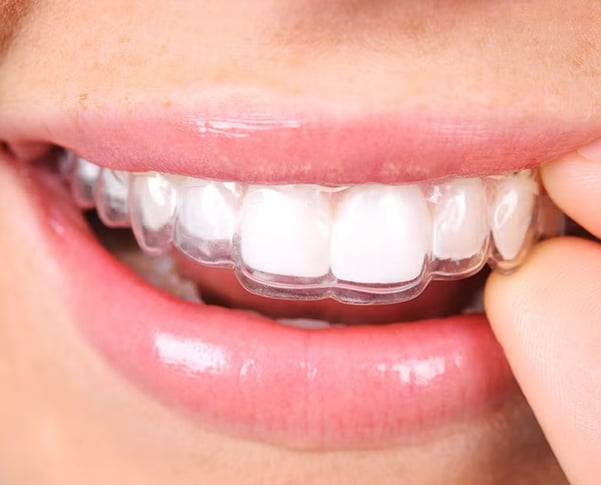 Invisalign