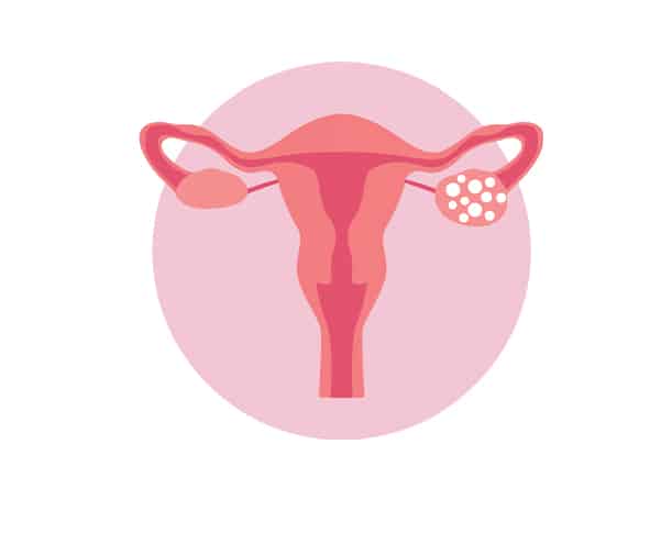 DPolycystic Ovary Syndrome (PCOS)